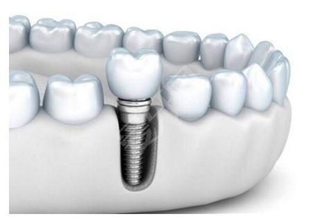 植牙该如何选择种植体品牌 成功和哪些因素有关