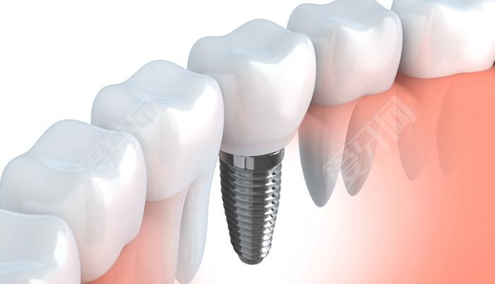 缺牙是植牙好还是镶牙好 具体有啥区