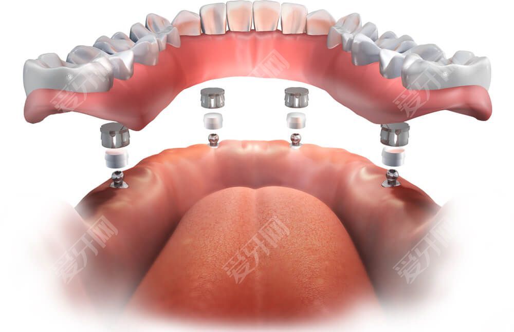 植牙过程究竟是怎么样的 影响植牙寿命的因素有哪些