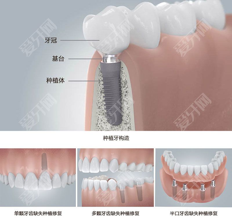 植牙过程究竟是怎么样的 影响植牙寿命的因素有哪些