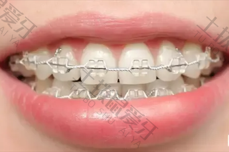 陶瓷类牙套