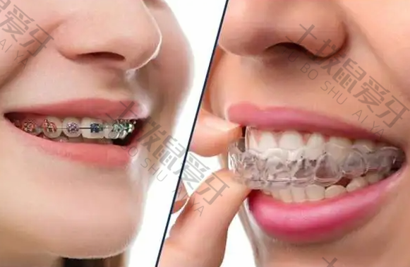 隐形牙套和普通金属牙套