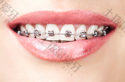 金属箍牙