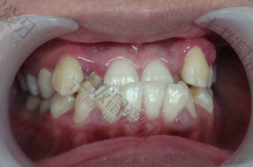 牙齿畸形类型