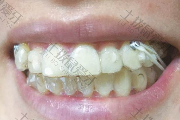 牙齿畸形情况