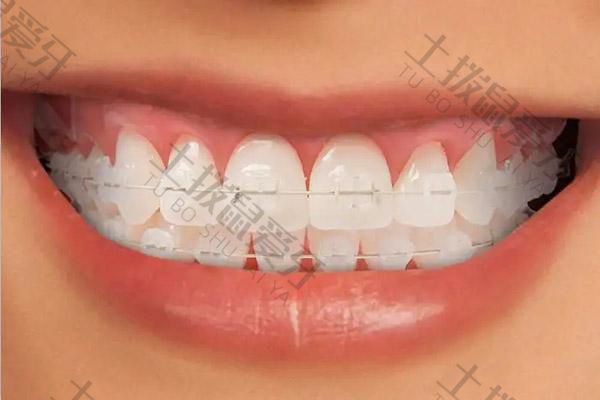 牙齿矫正方法优缺点