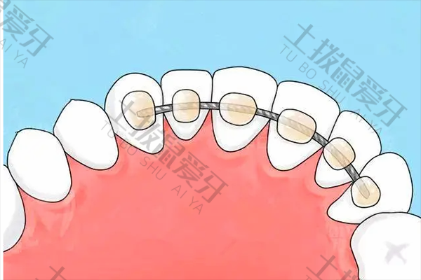 舌侧隐形矫正器多少钱 舌侧隐形矫正器什么样