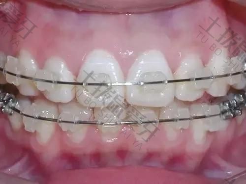 成人牙齿矫正时间多长 成人牙齿矫正时间多久