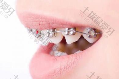 牙齿咬合不正怎么矫正 牙齿不整齐有几种方法可以矫正