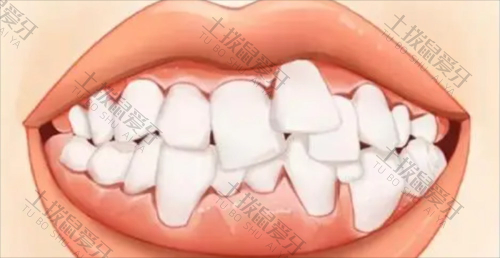 矫正牙齿拥挤一定要拔牙吗