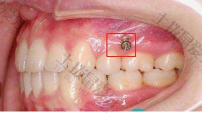 矫正牙齿拥挤需要打骨钉 牙齿矫正最佳年龄和最晚年龄