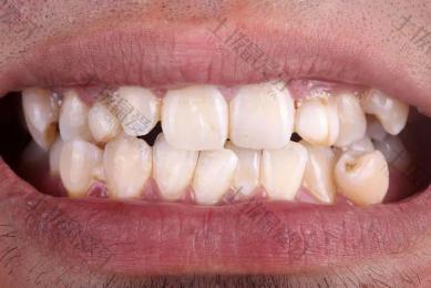 怎么矫正牙齿拥挤 牙齿矫正最佳年龄段
