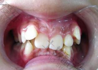 牙齿矫正几个月见效果 牙齿矫正多久可以收缝呢