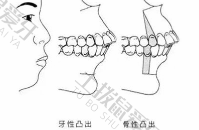 牙性龅牙跟骨性龅牙