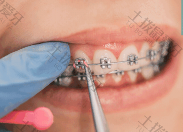 牙齿矫正带牙套一般要多久 牙齿矫正带牙套的最初几天牙特别疼吃止痛药管用吗