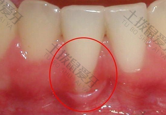 矫正牙齿牙龈萎缩是怎么回事