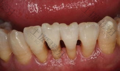 矫正牙齿牙龈萎缩可以恢复吗 矫正牙齿牙龈萎缩是什么原因