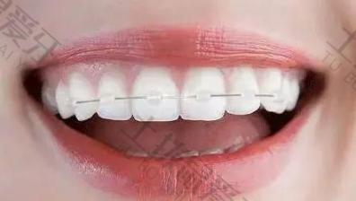 隐形矫正牙齿有效果吗 牙齿矫正隐形的好还是不隐形的好