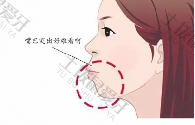 牙齿前突矫正多少钱 上颌前突矫正需要多久