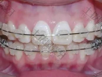 牙齿矫正半隐形价格多少钱 矫正牙齿的方法有哪几类