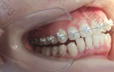 半隐形牙齿矫正价格 牙齿的矫正方法及差别