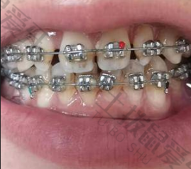 金属矫正和隐形矫正有什么区别 矫正牙齿用金属的好还是隐形的好