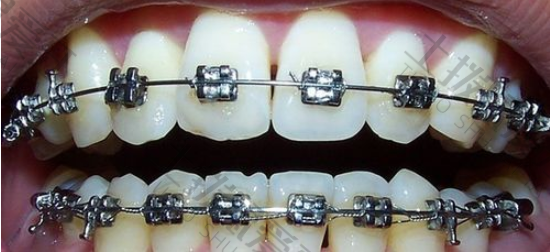 金属牙套和陶瓷牙套的优缺点