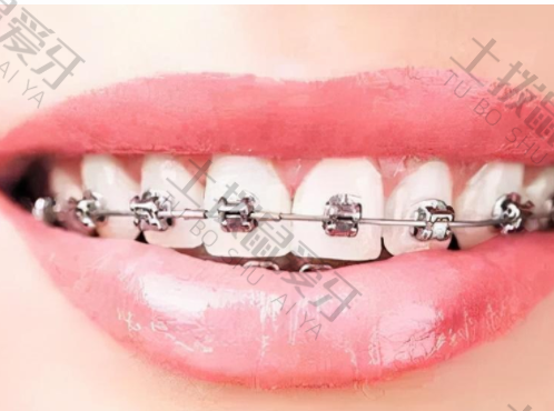 金属矫正牙齿需要多久