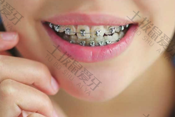 金属矫正牙齿需要多久