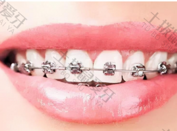 金属矫正牙齿需要多久 金属矫正牙齿是怎么固定的