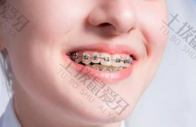 金属矫正可以洗牙吗 矫正牙齿的步骤跟过程