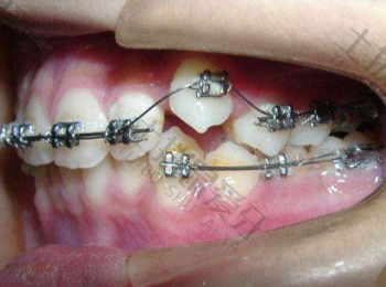 有金属牙套能做核磁吗 金属自锁牙套矫正原理