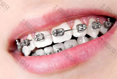 金属牙套和陶瓷牙套的优缺点 陶瓷牙套和金属牙套哪个对矫正牙齿更好