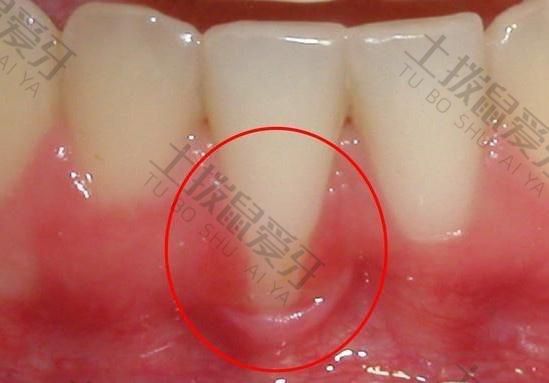种植牙质保期多长时间