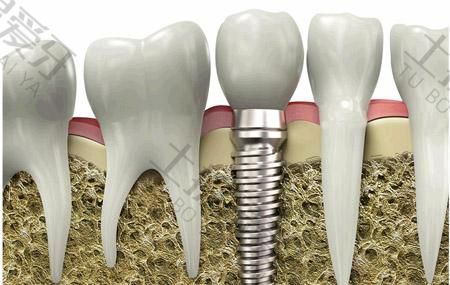 重庆口腔医院种植牙价格