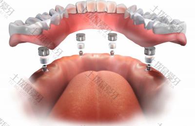 拔牙后多久种植牙有效果 种植牙后可以做核磁共振吗