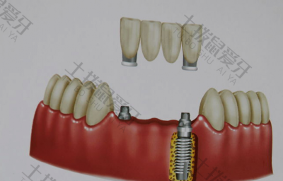 拔牙后种植牙最佳时期 种植牙安装基台后多久可以装牙冠