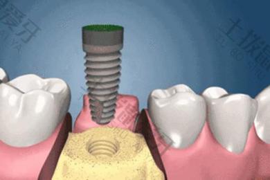 种植牙后出血大概多久 种植牙过程会流很多血
