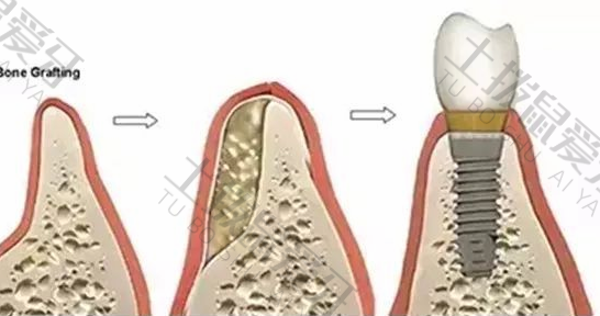 种植牙植骨后一直疼痛