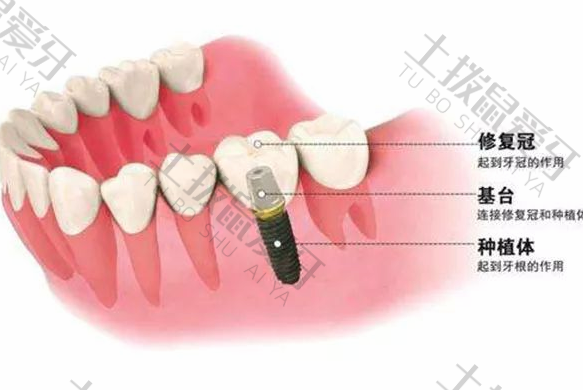 种植牙前几天需要注意什么