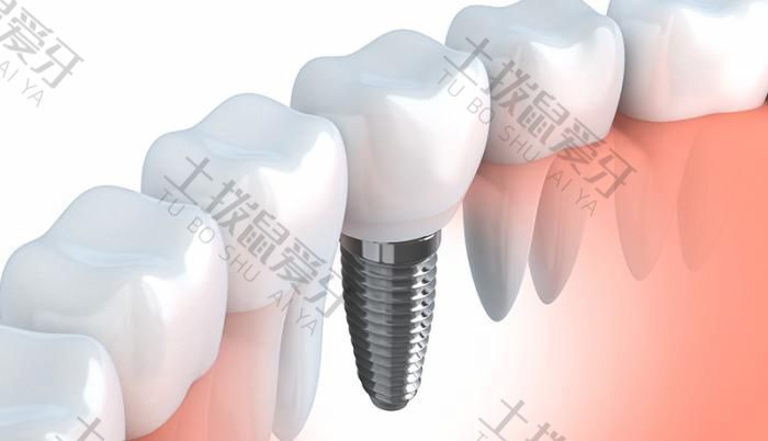 种植牙需不需要牙根