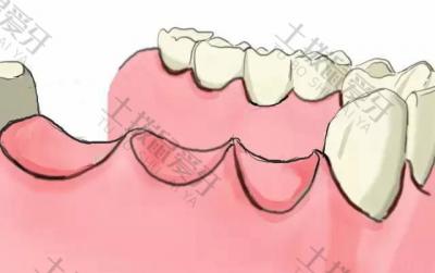 种植牙后牙龈发炎肿痛怎么办 种植牙牙龈萎缩怎么办