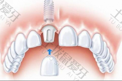 种植牙后牙龈发炎需要治疗多久 种植牙后牙龈发炎能治好吗
