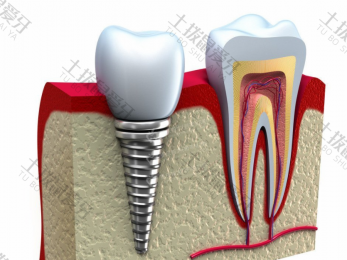 种植牙后一年牙根疼怎么办 种植牙后一年牙根疼正常吗
