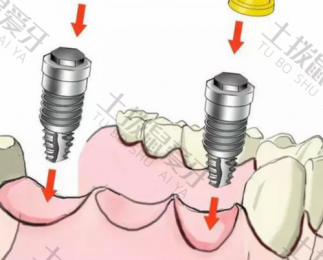 种植纯钛牙大约多少钱一颗 韩国奥齿泰种植牙价格