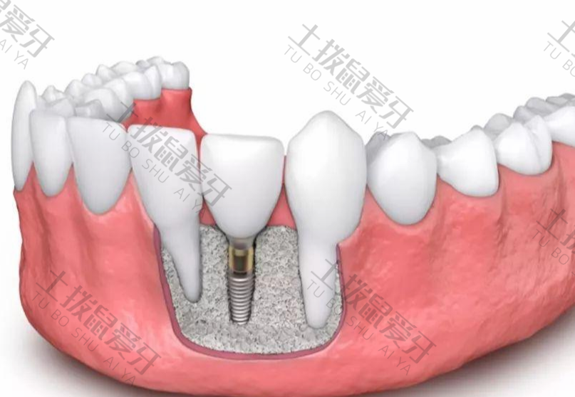 一颗种植牙大概价格是多少