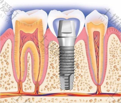 奥齿泰种植牙价格多少