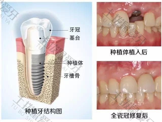 种植牙现在大概价格
