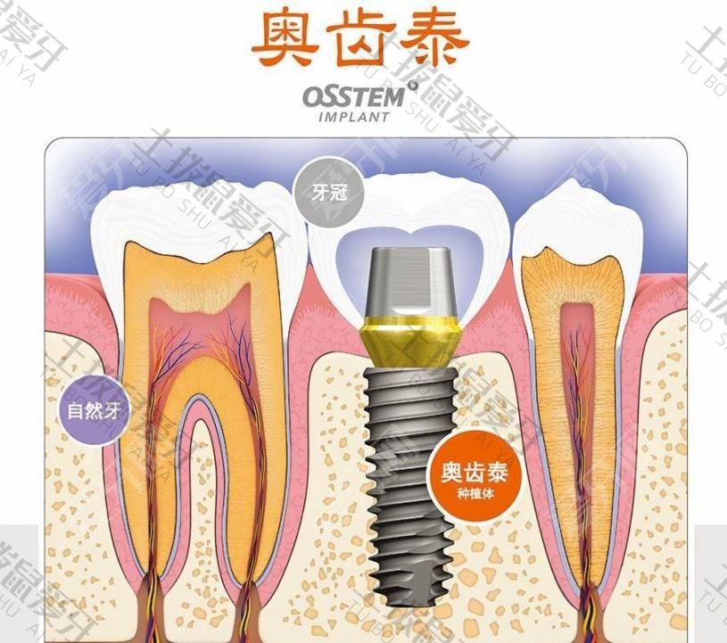 奥齿泰种植牙价格多少