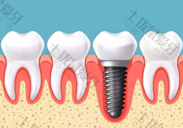 种植牙一颗什么价格